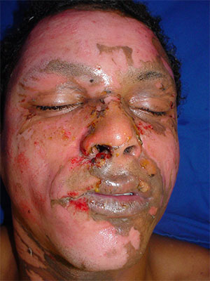 Before Mebracel Treatment